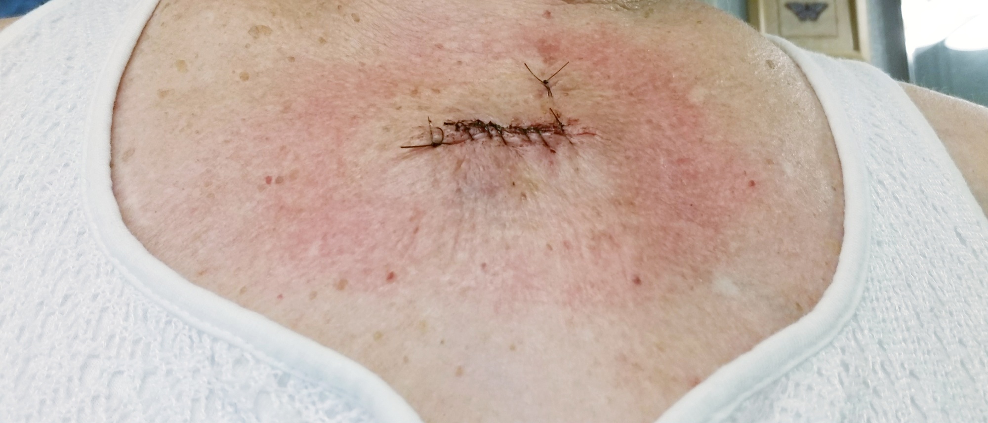 Melanoma! Skin Cancer! Sutures!
